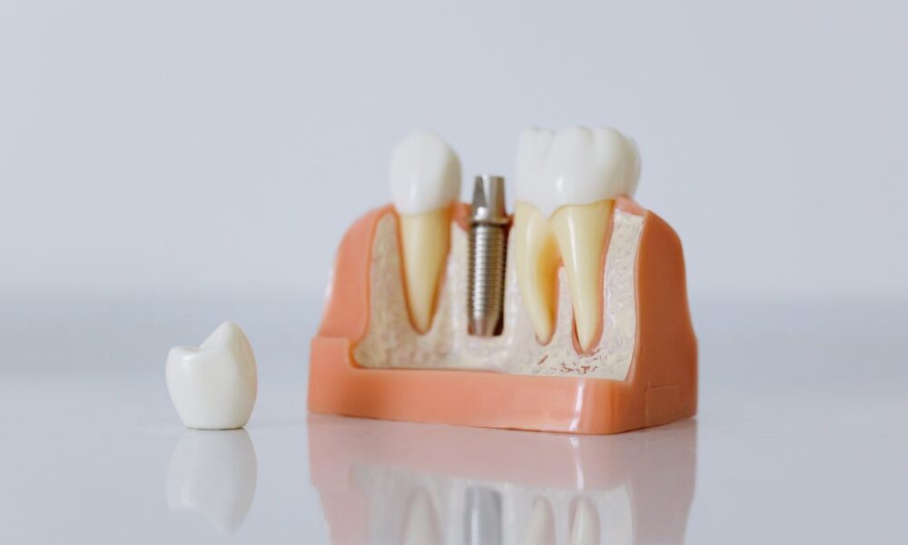 Korona, most czy implant? – kiedy warto zdecydować się na implant protetyczny