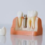 Korona, most czy implant? – kiedy warto zdecydować się na implant protetyczny